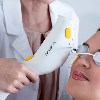 Optilight IPL Treatment